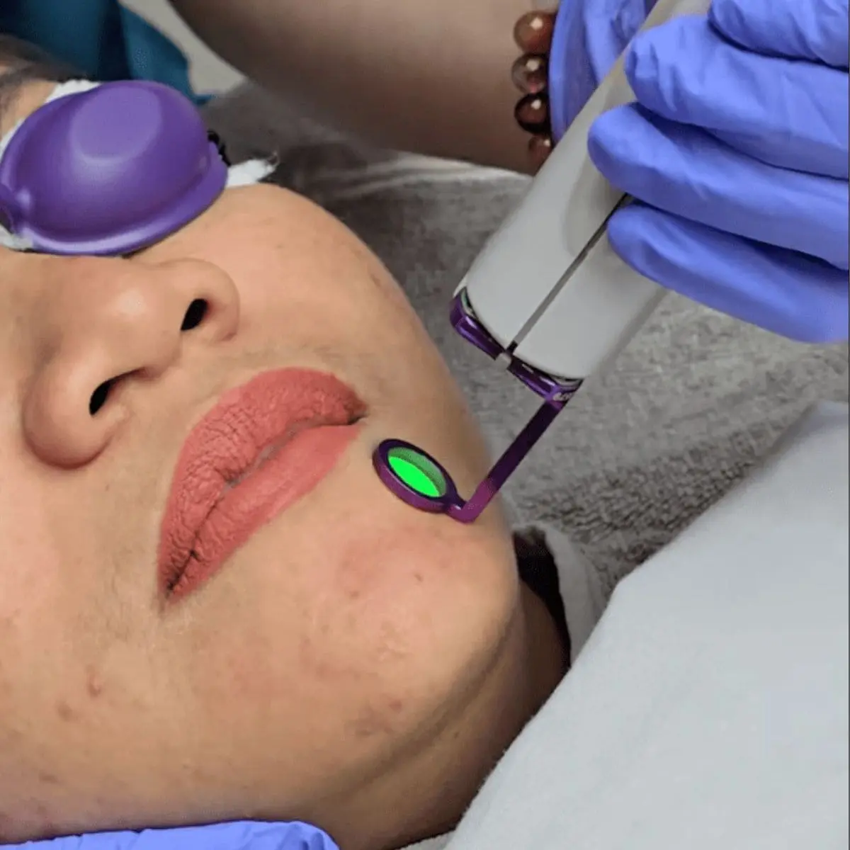 Laser Vbeam Perfecta